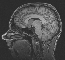 MRI provides excellent contrast between soft tissues