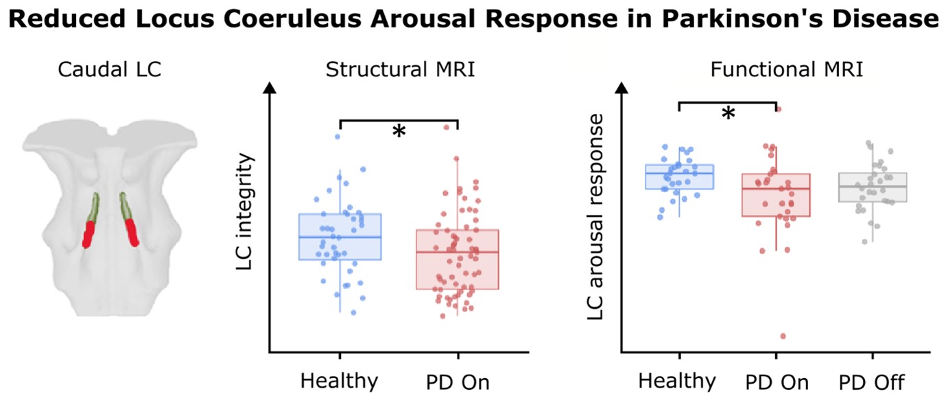 24032026 Imaging the function of a spaghetti in Parkinsons disease 1