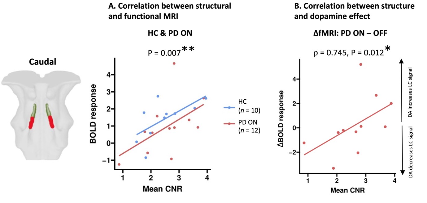 24032026 Imaging the function of a spaghetti in Parkinsons disease 2