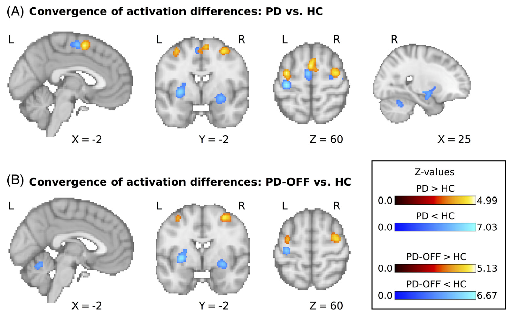 26012021 Brain Motor Network Changes in Parkinsons Disease figure 1