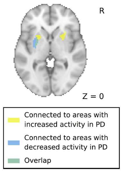 26012021 Brain Motor Network Changes in Parkinsons Disease figure 2