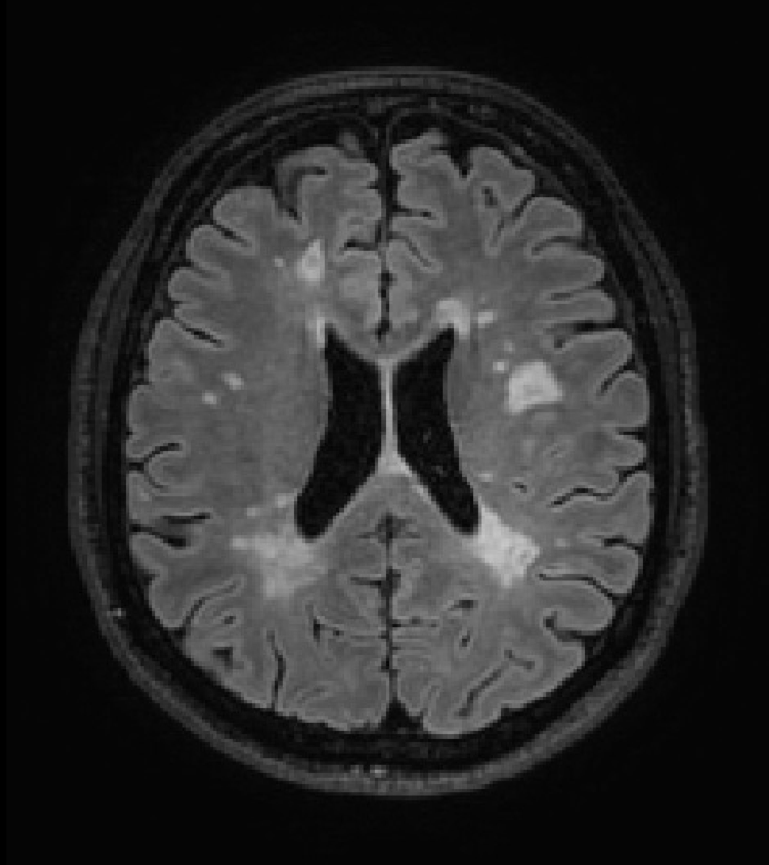 CI MRI