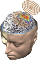 New understanding: The right side of the brain helps the left speak when the language is impaired by stroke